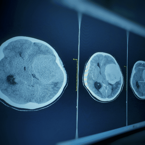 Brain Conditions We Treat