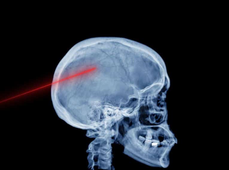 Hydrocephalus and
Shunt Procedures