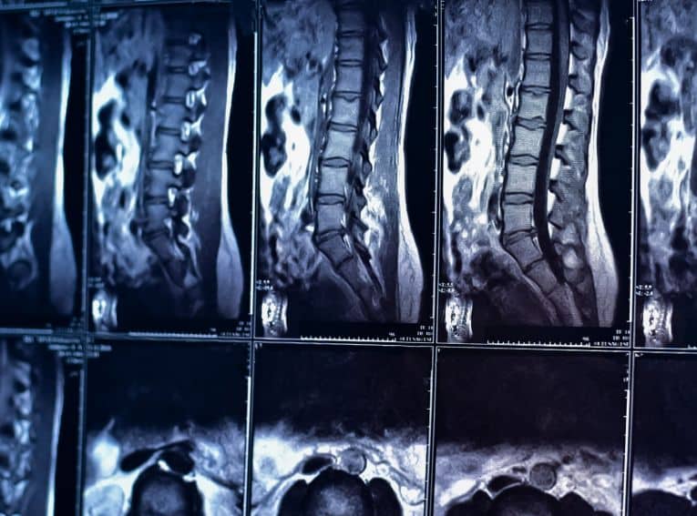 Minimally Invasive
Robotic Spine Surgery