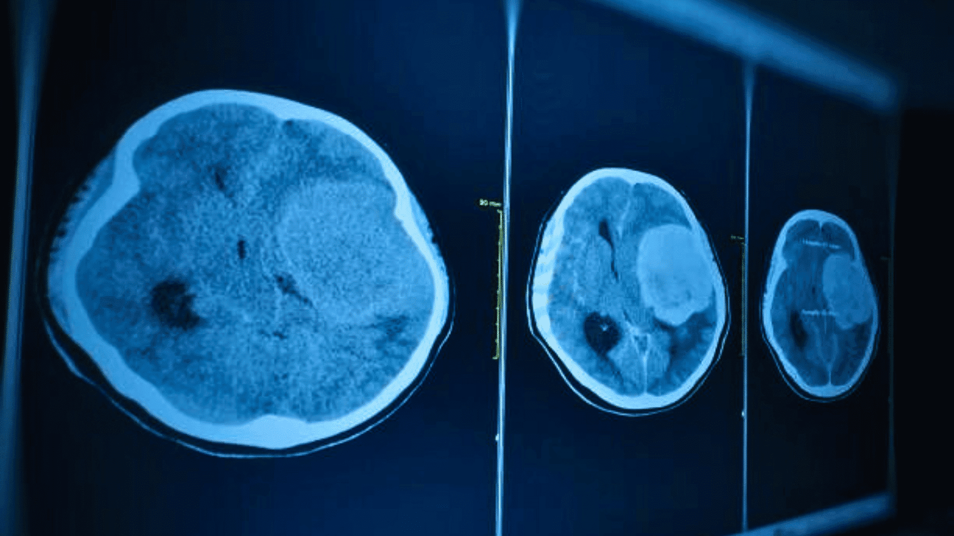 Embolization for
Subdural Hematoma Treatment
